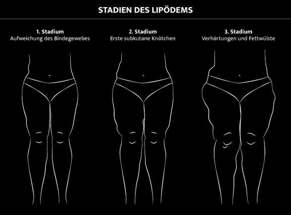 Grafik Stadien Lipödem, Dr. Deb, Central Aesthetics, Plastische Chirurgie & Schönheitschirurgie in Frankfurt