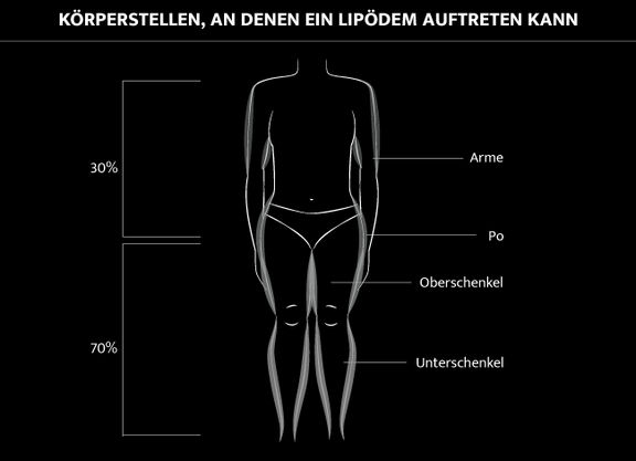 Grafik Körperstellen Lipödem, Dr. Deb, Central Aesthetics, Plastische Chirurgie & Schönheitschirurgie in Frankfurt