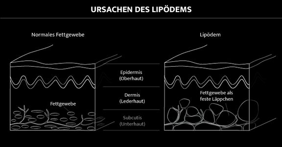 Grafik Ursachen Lipödem, Dr. Deb, Central Aesthetics, Plastische Chirurgie & Schönheitschirurgie in Frankfurt