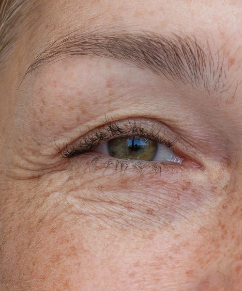 Augenlidstraffung Nachsorge