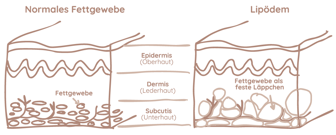 Lipödem Grafik
