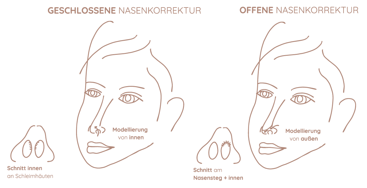 Nasenkorrektur Grafik Frankfurt