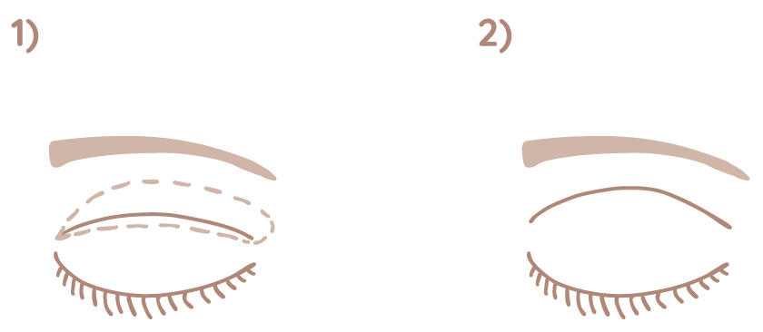 Oberlidstraffung Grafik Frankfurt