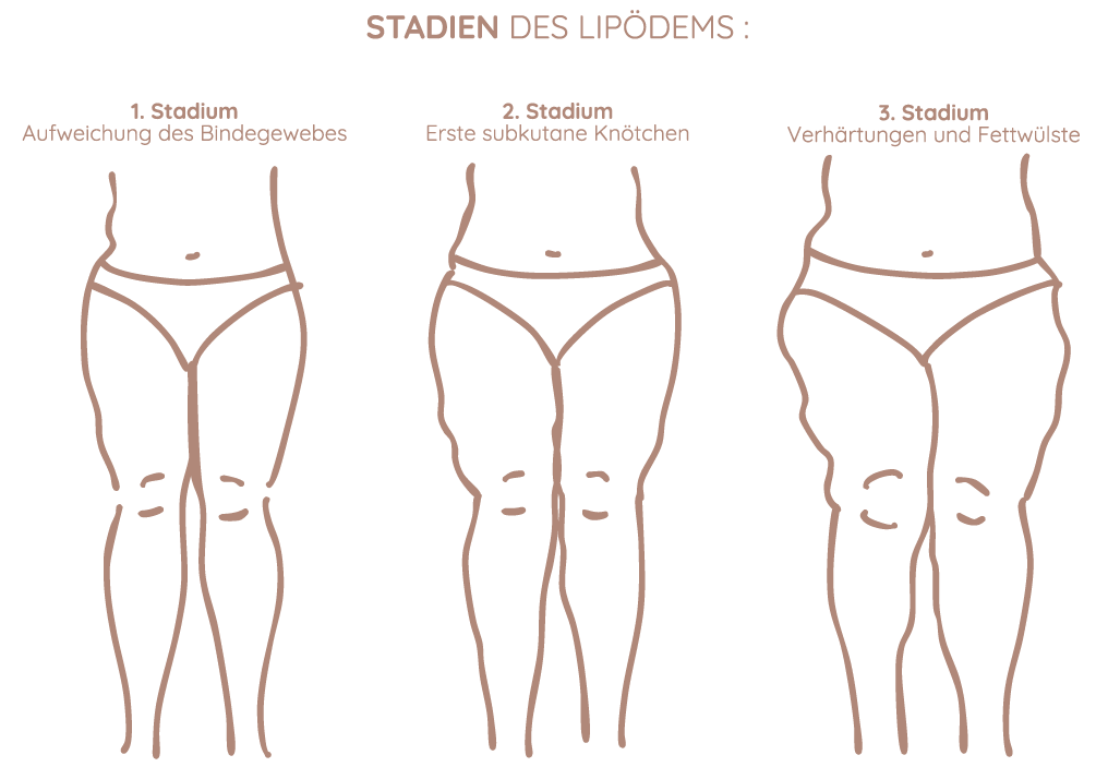 Stadien Lipödem Grafik